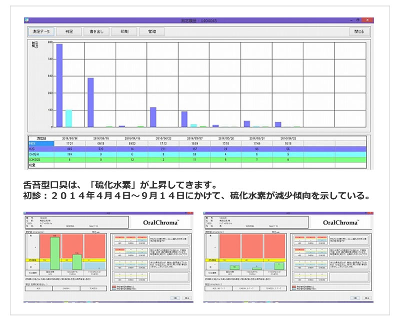 舌苔型口臭は、「硫化水素」が上昇してきます。初診：２０１４年４月４日～９月１４日にかけて、硫化水素が減少傾向を示している。